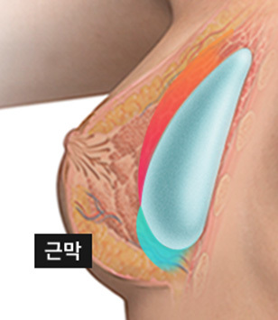 나나성형외과의 듀얼플레인 플러스 가슴성형