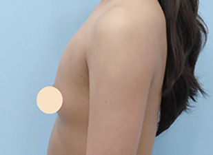 새가슴 FIT Before