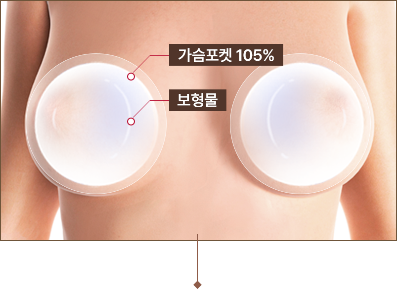가슴포켓 105% 보형물