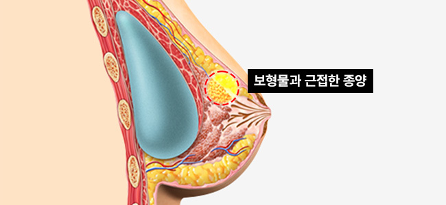 보형물 인접 종양 정밀 제거