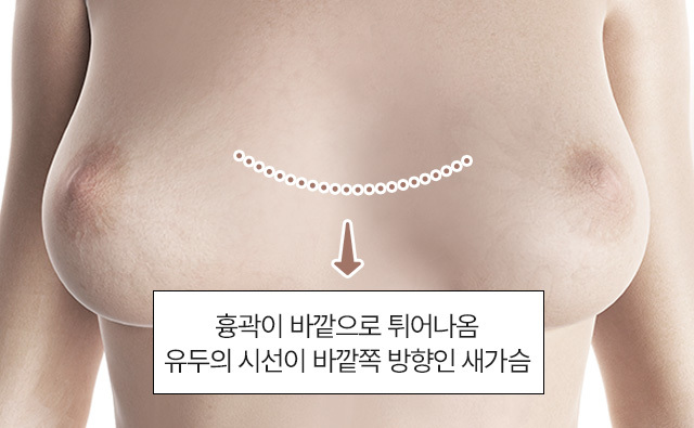 유두의 시선이 바깥쪽 방향인 새가슴