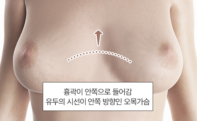 유두의 시선이 안쪽 방향인 오목가슴