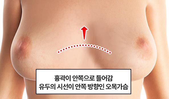여성이 가슴 보형물을 들고 있는 이미지