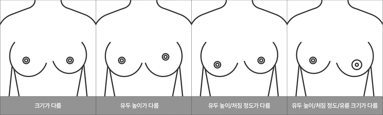 선천적 가슴 비대칭