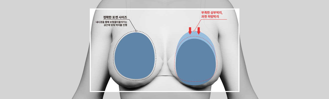 밑빠짐 수술 안내