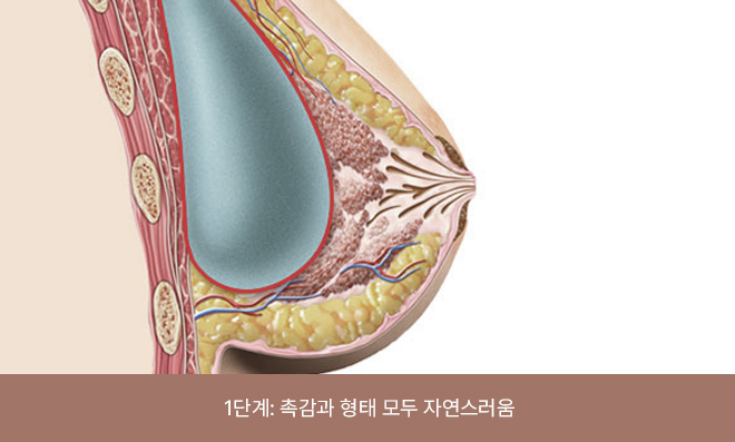 보형물이 만져지지 않으며 존재 여부를 인지하기 어려운 상태