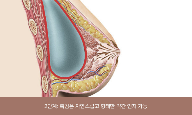 촉감은 부드럽고 보형물의 위치나 경계가 일부 느껴질 수 있음