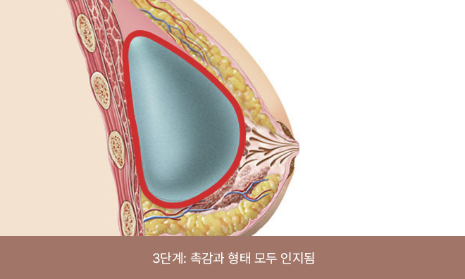 보형물이 단단하게 만져지고 가슴 모양에 변형이 나타남