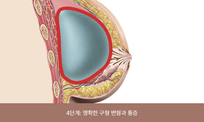 외관상 구형이 뚜렷하게 보이며, 통증이 동반되는 상태