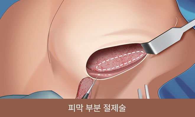 피막