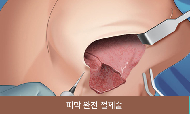 피막