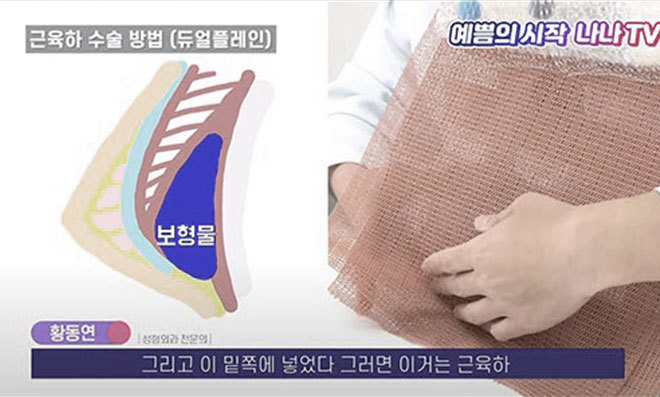 기존 이중평면 수술