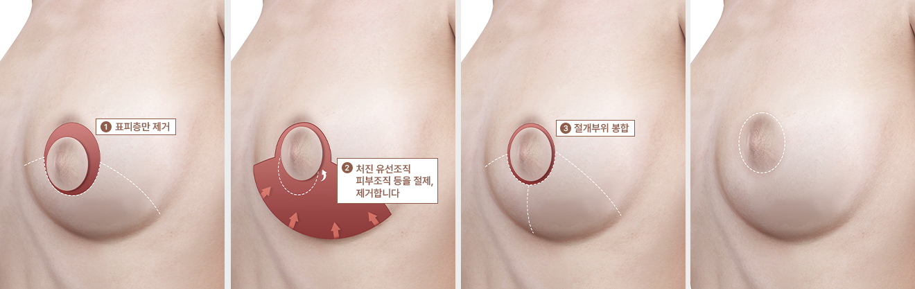 수직 절개법