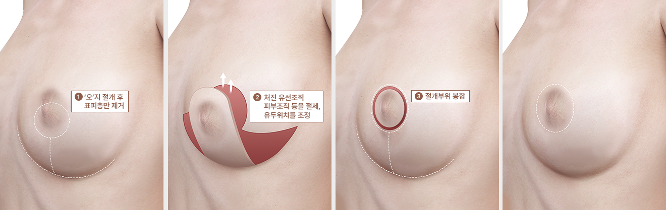 오자 절개법
