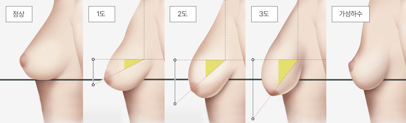 처진가슴 추천