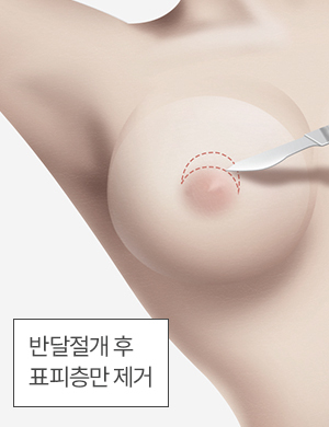 반달절개 후 표피층만 제거