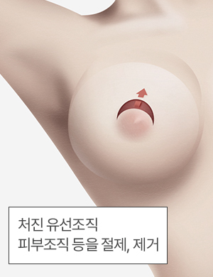 처진 유선조직 제거