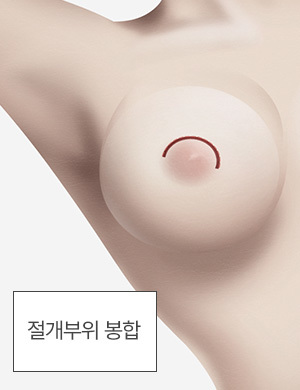 절개부위 봉합