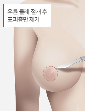 유륜 둘레 절개 후 표피층만 제거