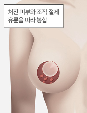처진 피부와 조직 절제