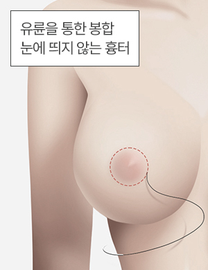 유륜을 통한 봉합