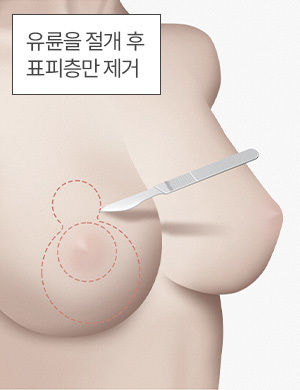 유륜을 절개 후 표피층만 제거