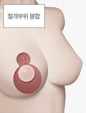 절개부위 봉합