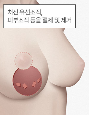 처진 유선조직, 피부조직 절제 및 제거