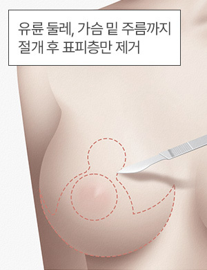 유륜 둘레, 가슴 밑 주름까지 절개 후 표피층만 제거