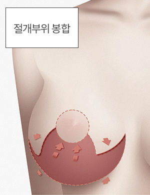 절개부위 봉합
