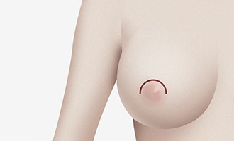 반달절개