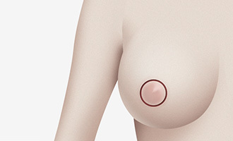 유륜절개